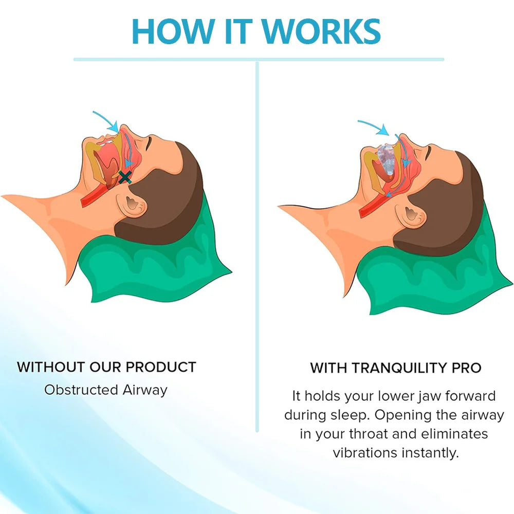 Anti Snore & Bruxism Mouth Guard